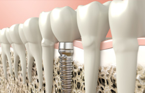 Dental Implants in Northridge and San Fernando Valley