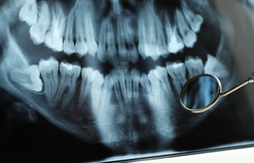 Dental X-Rays in Northridge and San Fernando Valley